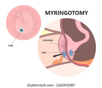 Perforated eardrum tube surgical drain Otitis media ear wax Hole repair sound canal tear pain pus bloody Hearing loss injury Middle fluid water Loud blasts microscopic acute bone cotton swab otoscopic