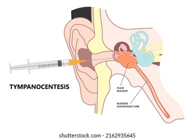 Perforated Eardrum Tube Surgical Drain Otitis Media Ear Wax Hole Repair Sound Canal Tear Pain Pus Bloody Hearing Loss Injury Middle Fluid Water Loud Blasts Microscopic Acute Bone Cotton Swab Otoscopic