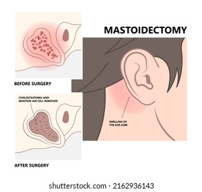 Symptome einer Mittelohrentzündung, die Rötung und Schwellung von Earlobe in der Medizin verursachen