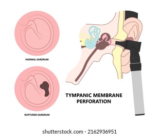 Perforated eardrum tube surgical drain Otitis media ear wax Hole repair sound canal tear pain pus bloody Hearing loss injury Middle fluid water Loud blasts microscopic acute bone cotton swab otoscopic