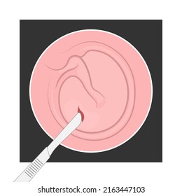 Perforated Eardrum Tube Surgical Drain Otitis Media Ear Wax Hole Repair Sound Canal Tear Pain Pus Bloody Hearing Loss Injury Middle Fluid Water Loud Blasts Microscopic Acute Bone Cotton Swab Otoscopic