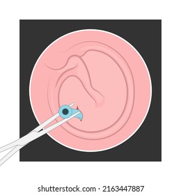 Perforated Eardrum Tube Surgical Drain Otitis Media Ear Wax Hole Repair Sound Canal Tear Pain Pus Bloody Hearing Loss Injury Middle Fluid Water Loud Blasts Microscopic Acute Bone Cotton Swab Otoscopic