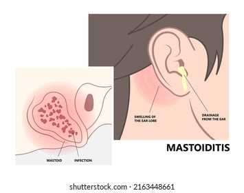 Perforated Eardrum Tube Surgical Drain Otitis Media Ear Wax Hole Repair Sound Canal Tear Pain Pus Bloody Hearing Loss Injury Middle Fluid Water Loud Blasts Microscopic Acute Bone Cotton Swab Otoscopic