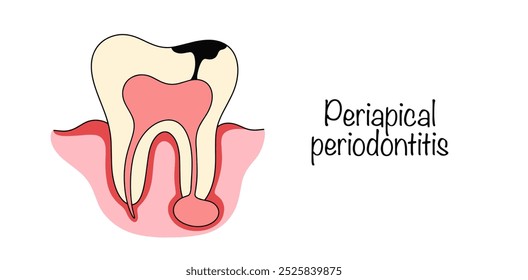 Periodontite periapical. Inflamação periodontal, que geralmente ocorre como resultado de pulpite não tratada. Inflamação por cárie, que se transformou em cisto de raiz dentária. Ilustração vetorial.