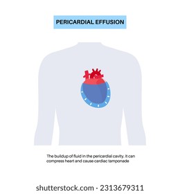 Pericardial effusion poster. Fluid in the space around the heart, cardiac tamponade cause. Inflamed internal organs, infection in the human body. Cardiovascular system medical vector illustration