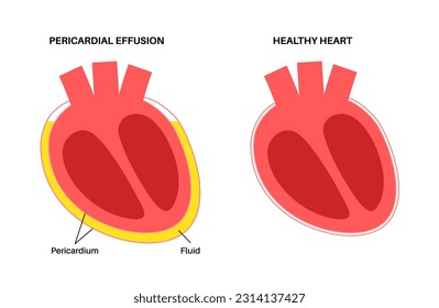 Afiche de derrame pericárdico. Líquido en el espacio alrededor del corazón, causa de tamponade cardíaco. Órganos internos inflamados, infección en el cuerpo humano. Ilustración cardiovascular de vectores médicos