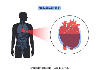 Afiche de derrame pericárdico. Líquido en el espacio alrededor del corazón, causa de tamponade cardíaco. Órganos internos inflamados, infección en el cuerpo humano. Ilustración cardiovascular de vectores médicos