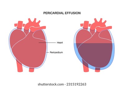 Pericardial effusion poster. Fluid in the space around the heart, cardiac tamponade cause. Inflamed internal organs, infection in the human body. Cardiovascular system medical vector illustration
