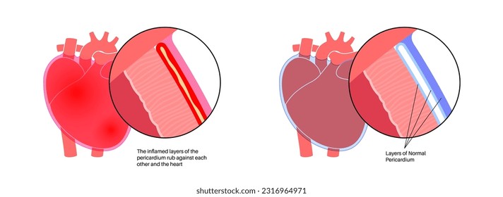 Pericarditis anatomical poster. Heart wall inflammation. Chest pain symptom. Inflamed internal organs concept. Viral infection in the human body. Cardiovascular system medical flat vector illustration