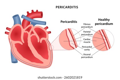 Pericarditis, inflammation of the lining of the heart. Medical illustration of human heart with an enlargement of the pathological area of ​​lining of heart. Vector illustration in flat style