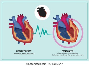 Pericarditis is inflammation of the outer lining of the heart. Editable Clip Art comparison between healthy and problematic areas.