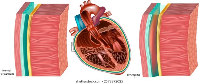 Pericarditis and Normal Pericardium Medical Illustration. Cross-Section of the Heart with Pericarditis. Heart Inflammation Structure Diagram