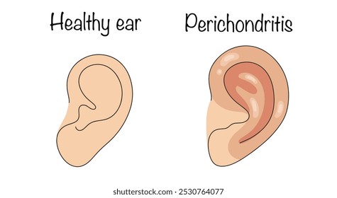 Perichondritis. An inflammatory process occurring in the tissues of the perichondrium or perichondrium. Healthy ear and ear with cartilage pathology. Vector illustration for use in the medical field.