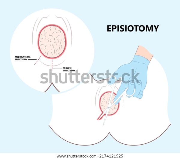 perineal tear of the vagina\
obstetrician give birth labor baby medio lateral anal woman with\
C-section