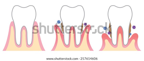 Periodontal Disease Stock Vector (Royalty Free) 257614606 | Shutterstock