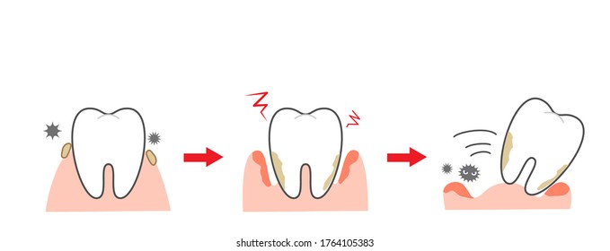 Periodontal disease bleeding toothpaste 　illustrations