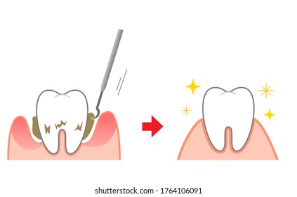 Periodontal disease bleeding toothpaste  illustrations
