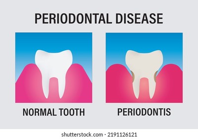 1 Enfermedad Periodontal Images, Stock Photos & Vectors | Shutterstock