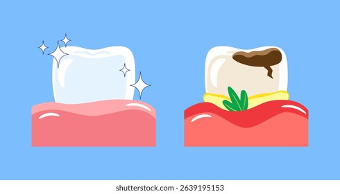 Periodontal disease . Included gingivitis, dental calculus, gum recession and food stuck in teeth . Cartoon illustration . Isolated on blue background . Vector . 