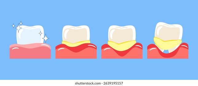 Periodontal disease . Included gingivitis, dental calculus, gum recession and food stuck in teeth . Cartoon illustration . Isolated on blue background . Vector . 