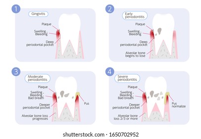 Periodontal disease progression illustration, 4 stages
