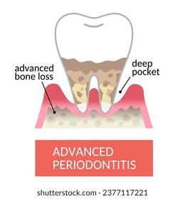 periodontal pocket and bone destruction. destroyed bone cause teeth to become loose and fall out.   Dental and oral care concept.