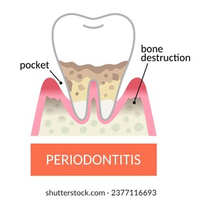 periodontal pocket and bone destruction. lose more bone around teeth and develop periodontal pockets.  Dental and oral care concept.