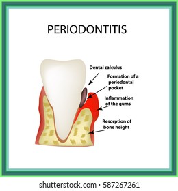 Periodontitis Dental Disease Inflammation Gums Tooth Stock Illustration ...