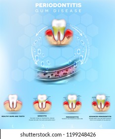 Periodontitis Formation, Inflammation Of The Gums Bacteria Can Enter In To The Blood Stream And Initiate Complications In Other Parts Of Body, Such As Stroke, Diabetes And Heart Disease