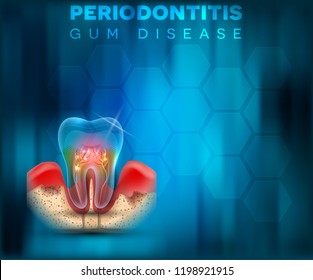 Periodontitis gum disease poster, inflammation of the gums on a bright blue mesh background