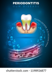 Periodontitis, Inflammation Of The Gums Bacteria Can Enter In To The Blood Stream And Initiate Complications In Other Parts Of Body, Such As Stroke, Diabetes And Heart Disease