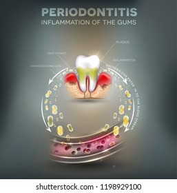 Periodontitis, Inflammation Of The Gums Bacteria Can Enter In To The Blood Stream And Initiate Complications In Other Parts Of Body, Such As Stroke, Diabetes And Heart Disease