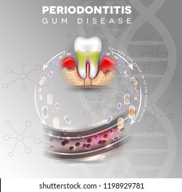 Periodontitis, Inflammation Of The Gums Bacteria Can Enter In To The Blood Stream And Initiate Complications In Other Parts Of Body, Such As Stroke, Diabetes And Heart Disease