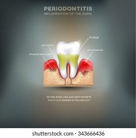Periodontitis, inflammation of the gums, detailed illustration on a beautiful grey mesh background