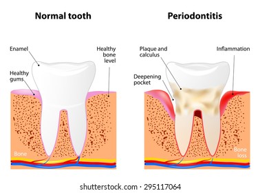 Periodontitis is a inflammatory diseases affecting the periodontium, the tissues that surround and support the teeth