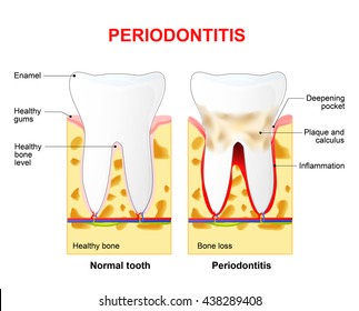 Periodontitis Inflammatory Diseases Affecting Periodontium Tissues ...