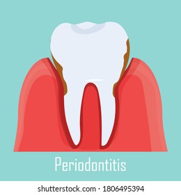 Periodontitis-Problem, Kaugummi krank. Illustration von menschlichen Zahn mit Zahnentzündung einzeln. 