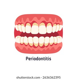 Periodontitis, severe gum infection, tooth and bone loss, poor oral hygiene