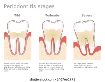 Periodontitis estadifica ilustración médica. Tres etapas de la enfermedad periodontal en la Ilustración vectorial dental. 