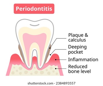 periodontitis tooth and gums. periodontal pocket and bone destruction. Dental and oral care concept.