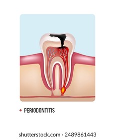 Periodontitis. Tooth with periodontitis. Vector clipart isolated on white background.