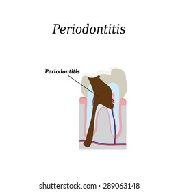 Periodontitis tooth. Vector illustration on isolated background.