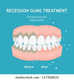 Periodontitis vector. Recession gums treatment. Stomatology dentistry concept