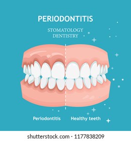 Periodontitis vector. Recession gums treatment. Stomatology dentistry concept