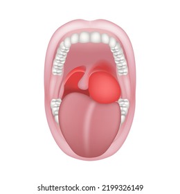 Peripharyngealer Abszess. Purulente Entzündung des Gewebes des peripharyngealen Raumes. Großer offener Mund mit Zähnen. Vektorgrafik