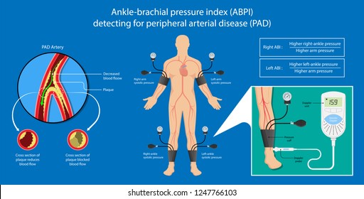 Peripheral Artery Disease Ankle Brachial Index ABI Test Limb Ischemia Diagnosis Vascular ABPI Blockage