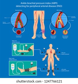 Peripheral Artery Disease Ankle Brachial Index ABI Test Limb Ischemia Diagnosis Vascular ABPI Blockage