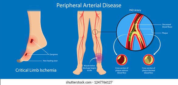 Peripheral Artery Disease Ankle Brachial Index ABI Test Limb Ischemia Diagnosis Vascular ABPI Blockage