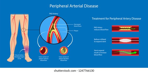 Peripheral Artery Disease Ankle Brachial Index ABI Test Limb Ischemia Diagnosis Vascular ABPI Blockage