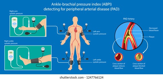 Brachial Ankle Index Chart